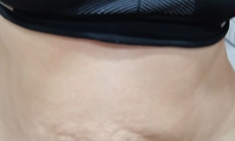 Tratamiento abdomen colgante y abultado - 83588