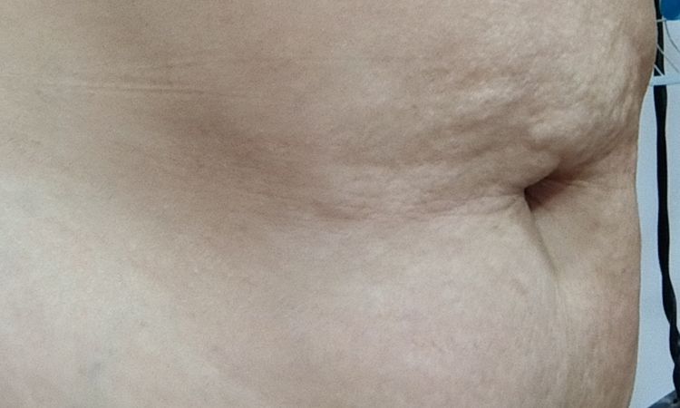 Tratamiento abdomen colgante y abultado - 83589