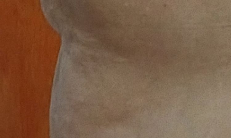 Tratamiento abdomen colgante y abultado - 83590