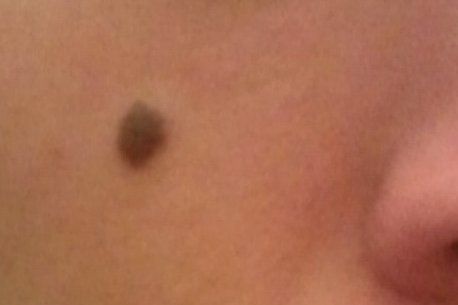 Eliminar lunares rostro