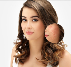 Tratamientos para el acné