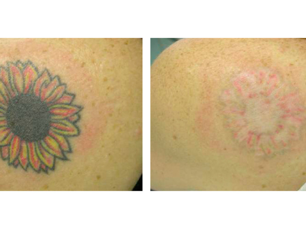 Antes y después de la eliminación de tatuaje.
