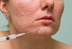 Inyecciones de ácido hialurónico