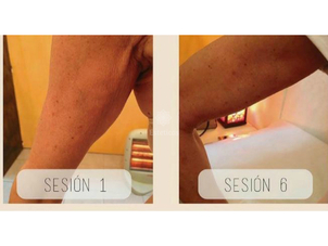 Antes y después de la carboxiterapia