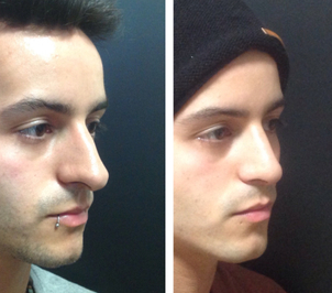 antes y después rinoplastia