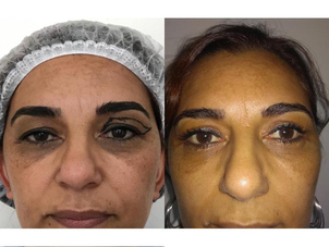 Blefaroplastia