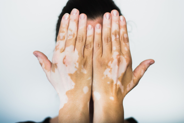 Representación de piel con vitiligo.