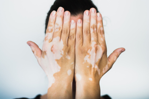 Representación de piel con vitiligo.