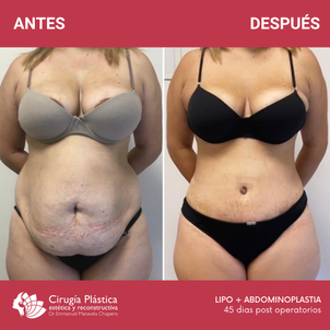 Cicatriz abdominoplastia