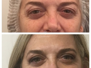 Cirugía de párpados