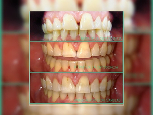 ¿Cómo saber si sos candidato a la ortodoncia invisible?