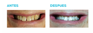 Blanqueamiento dental