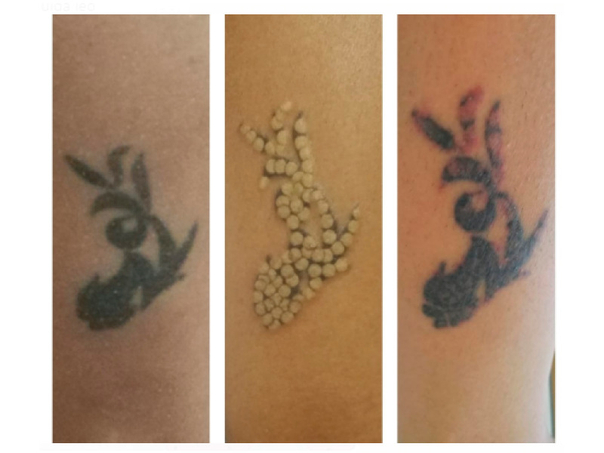 Tratamientos corporales eliminación de tatuajes