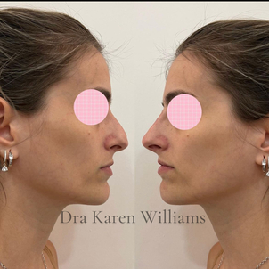 Diferencia entre rinoplastia y rinomodelación.