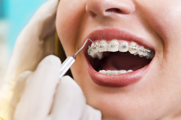 ¿Cómo se realiza la ortodoncia?