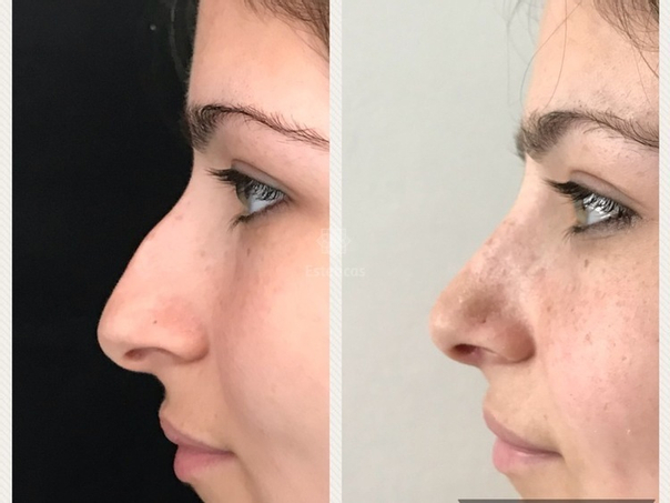 Técnicas de la cirugía de la nariz