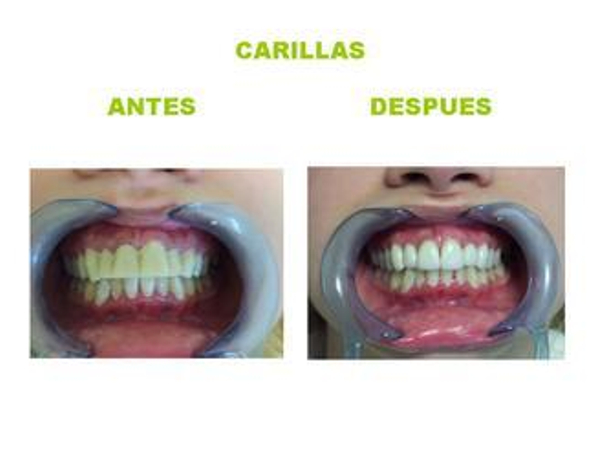 Carillas dentales, realización del proceimiento