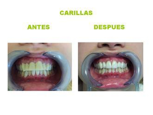 Carillas dentales, realización del proceimiento