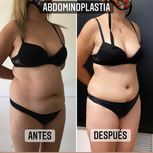 Candidatos a la abdominoplastia