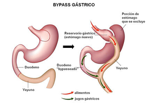 Bypass gástrico