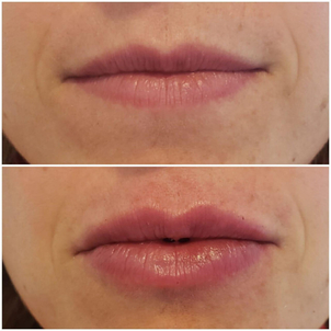 tipos de rellenos faciales