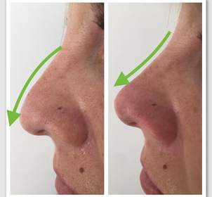 Recuperación tras una rinomodelación.