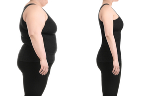 Cirugía bariátrica