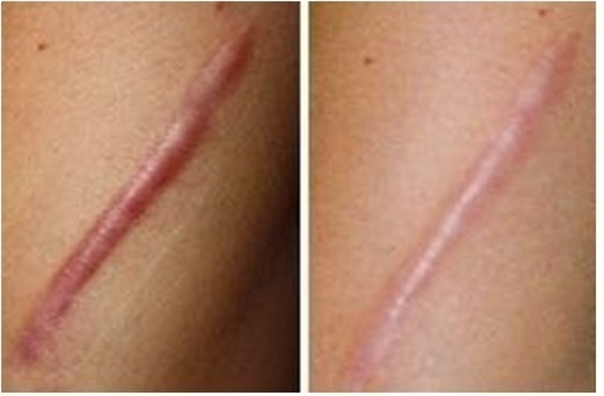 Tipos de cicatriz