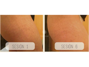 Resultado de la carboxiterapia