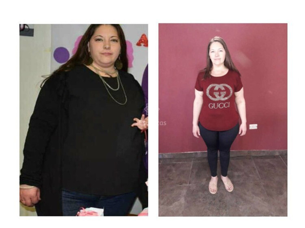 Antes y después de obesidad.