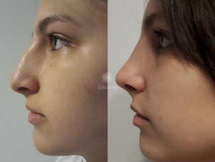 Consejos rinoplastia