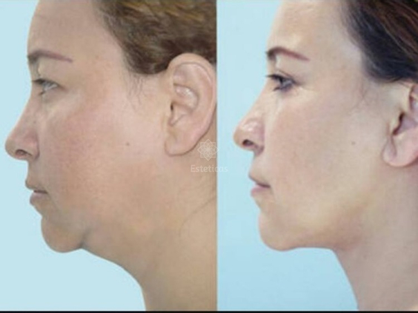 Antes y después de la cirugía maxilofacial
