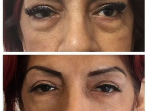 antes y después relleno ojeras