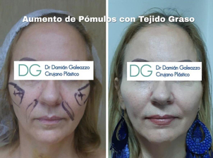 Ácido Hialurónico, antes y después