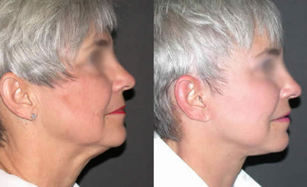 Recuperación del tratamiento de rejuvenecimiento facial.