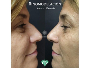 Definición de rinomodelación.