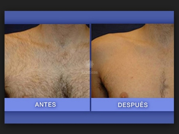 Antes y después de la depilación láser
