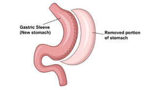 Ilustración manga gástrica