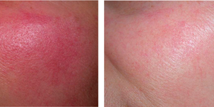 Antes y después del tratamiento para la rosácea.