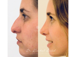 Posoperatorio de la rinoplastia