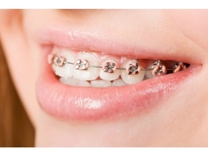 ¿Qué es la ortodoncia?