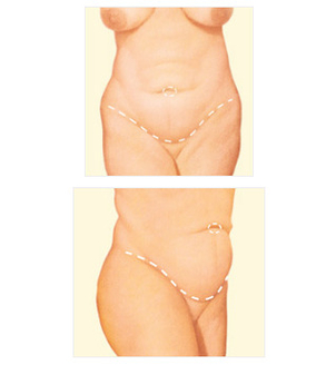 Corrección de abdomen