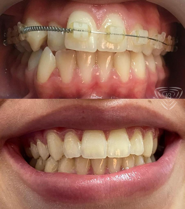 ¿Cómo es la recuperación de la ortodoncia?