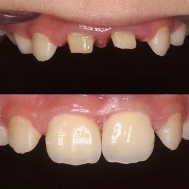 Implante dental