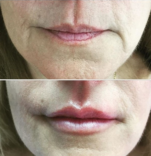 Beneficios del rejuvenecimiento facial.