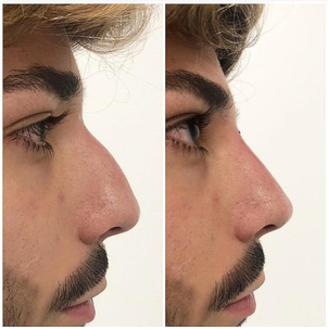 Beneficios de la rinomodelación