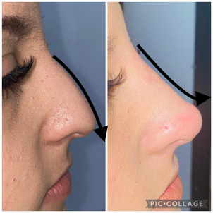 Rellenos utilizados en la rinomodelación.