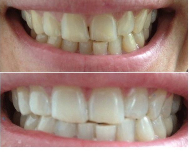 Antes y Después blanqueamiento dental