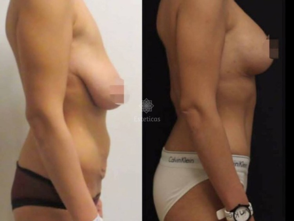 Antes y después de la cirugía