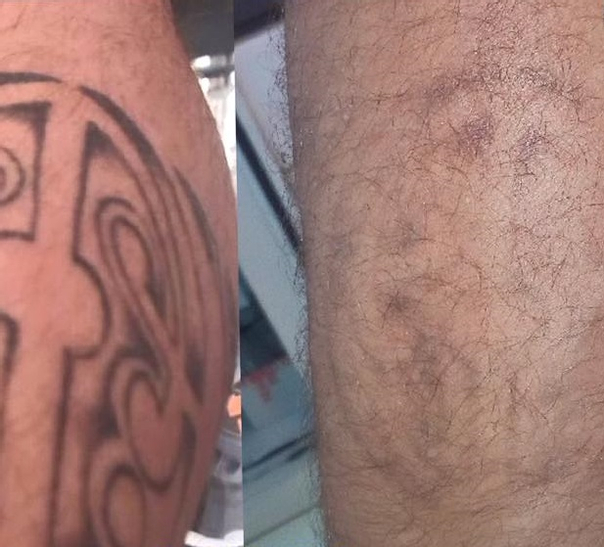 Imagen de antes y después de eliminación de tatuaje. 